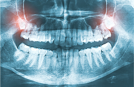 歯の再植固定