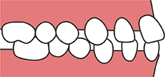 歯間に隙間がある
