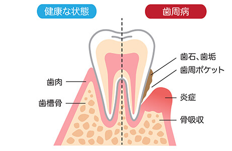 歯周病の原因