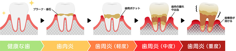 歯周病の原因