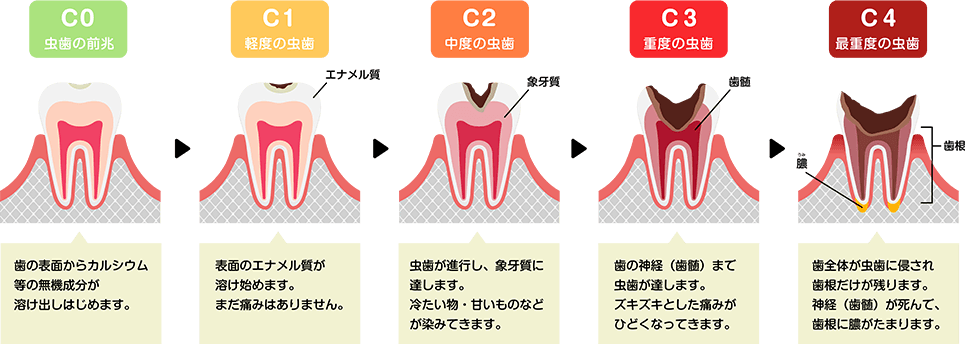 むし歯の進行